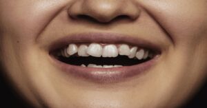 Maloklüzyon Tedavisi Maloklüzyon Tedavisi
