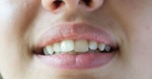 Maloklüzyon Tedavisi Maloklüzyon Tedavisi