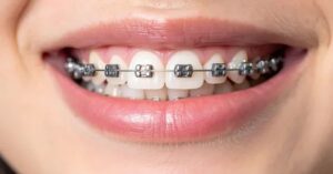 Diş Teli Uygulaması Diş Teli Uygulaması