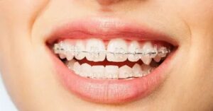 Diş Teli Uygulaması Diş Teli Uygulaması