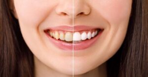 Diş Beyazlatma Yöntemleri Diş Beyazlatma Yöntemleri