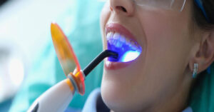 Diş Beyazlatma Yöntemleri Diş Beyazlatma Yöntemleri