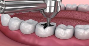 Diş Dolgusu Nasıl Yapılır? Diş Dolgusu Nasıl Yapılır?