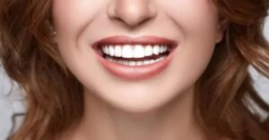 Gülüş Estetiği Nedir? Gülüş Estetiği Nedir?