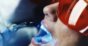 Diş Beyazlatma Tedavisi Diş Beyazlatma Tedavisi