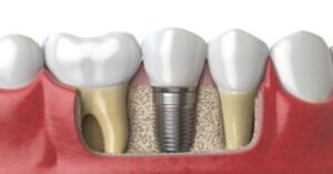 Dental İmplant Fiyatları Dental İmplant Fiyatları