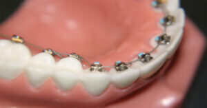 Lingual Ortodonti Nedir?