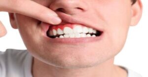 Diş Eti Çekilmesi Diş Eti Çekilmesi