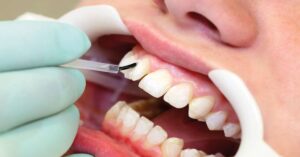 Bonding Tedavisi Bonding Tedavisi