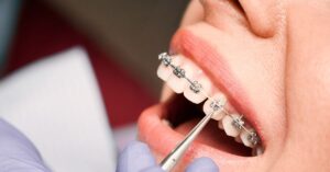 Diş Teli Tedavisi Nasıl Yapılır? Diş Teli Tedavisi Nasıl Yapılır?