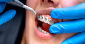 Diş Teli Tedavisi Nasıl Yapılır? Diş Teli Tedavisi Nasıl Yapılır?