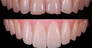 Bonding Tedavisi Nedir? Bonding Tedavisi Nedir?